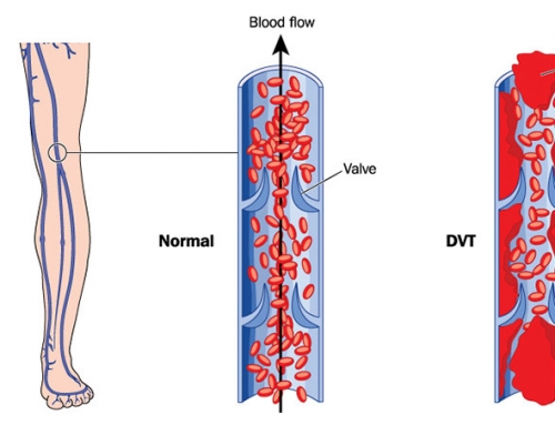 What are the signs and symptoms of Thrombophilia?
